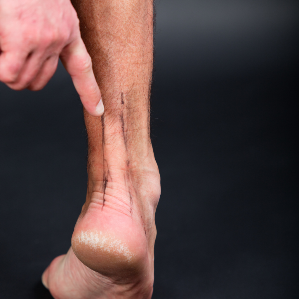 trattamenti per tendinite a Foligno
